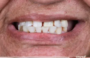 Antes - Prótese Protocolo